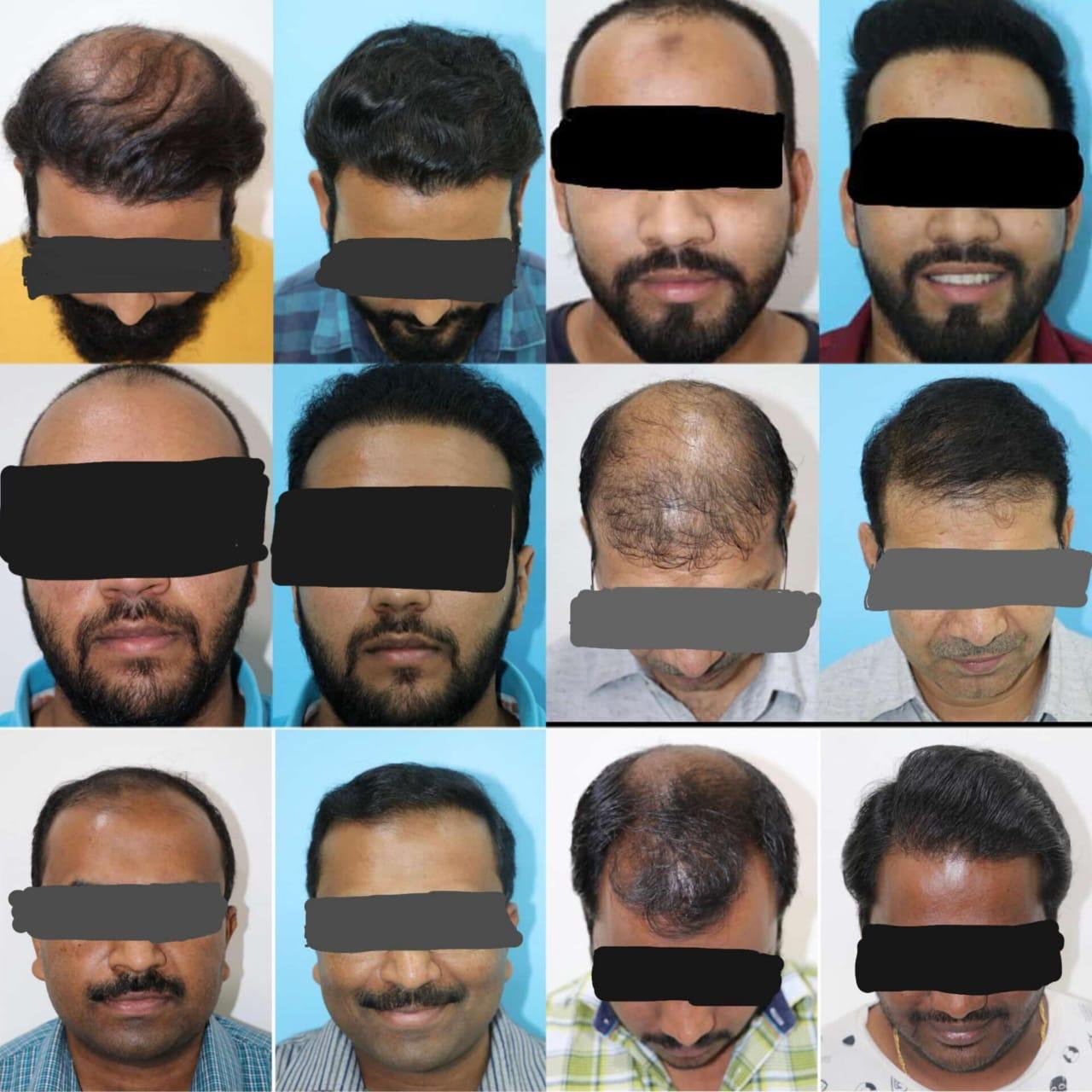 hair transplant